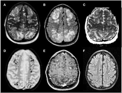 Central Nervous System Complications in Children Receiving Chemotherapy or Hematopoietic Stem Cell Transplantation